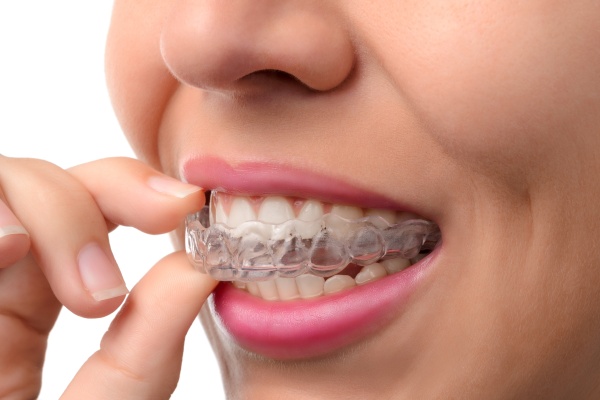 An Invisalign Dentist Shares The Benefits Of Invisalign®
