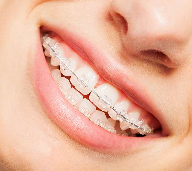 Hesperia Clear Braces