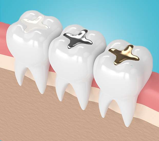 Hesperia Composite Fillings