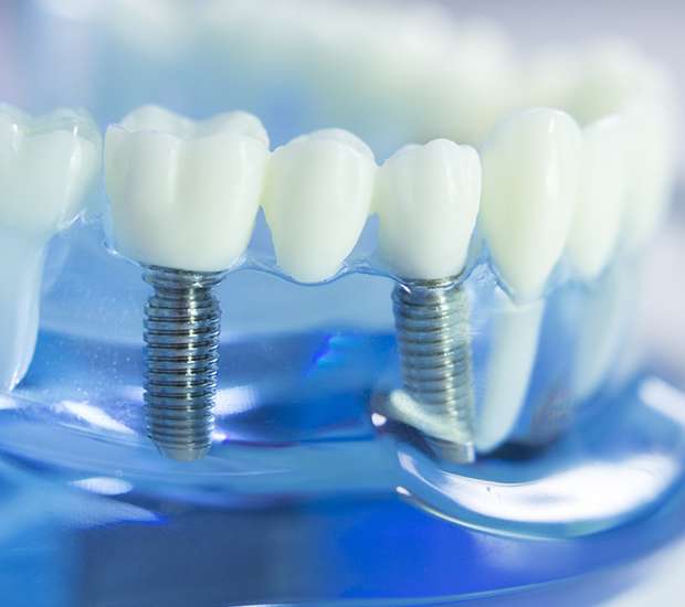 Hesperia Dental Implants