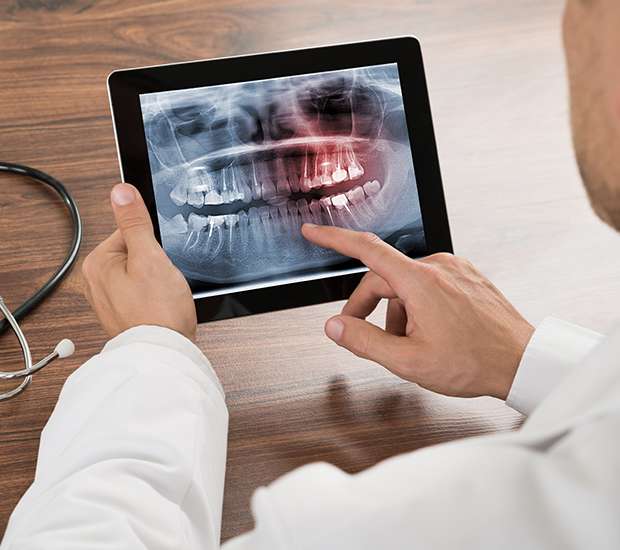 Hesperia Types of Dental Root Fractures